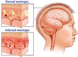 images.MENINGITIS.