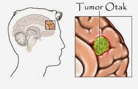 index.tumor.otak.