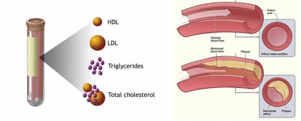 Ketahui Kadar Lipid dengan Parameter Ini