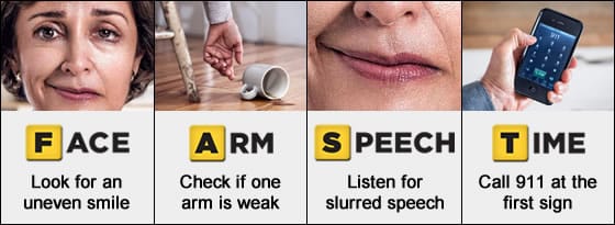 FAST metode stroke