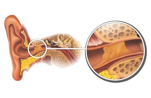 Earwax, Amankah untuk Pendengaran?