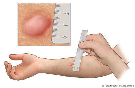 Hasil Tes Tuberkulin yang kemudian diukur atau dianalisa oleh tenaga kesehatan