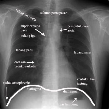 chest-xray modif