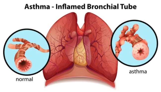 asthma_fr5tghyj