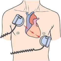 Defibrillator, ‘Alat Setrum Jantung’ yang Sering Disalahpersepsikan