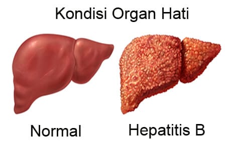 hepatitis B