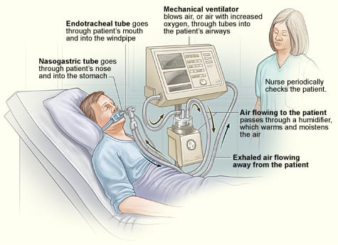 Ventilator dok NHLBI