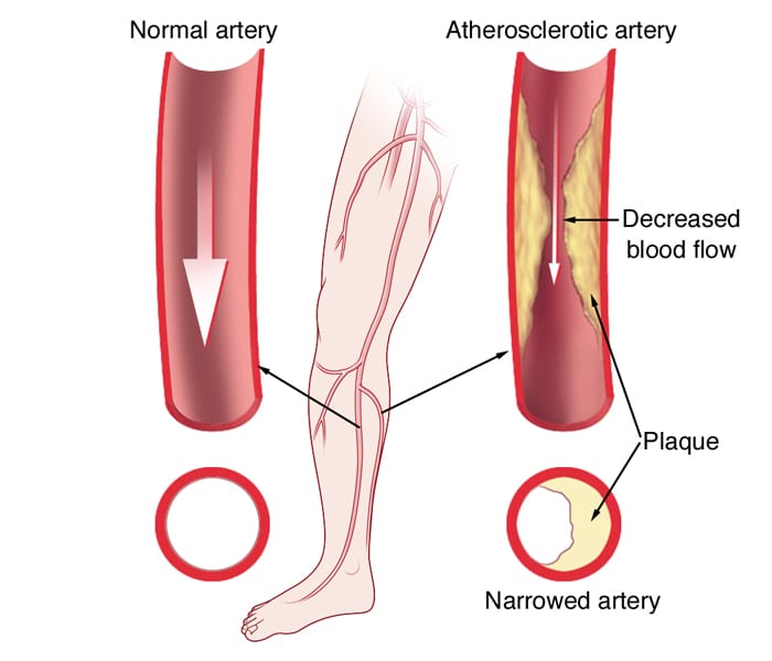 PAD atherosclerosislegSJMO