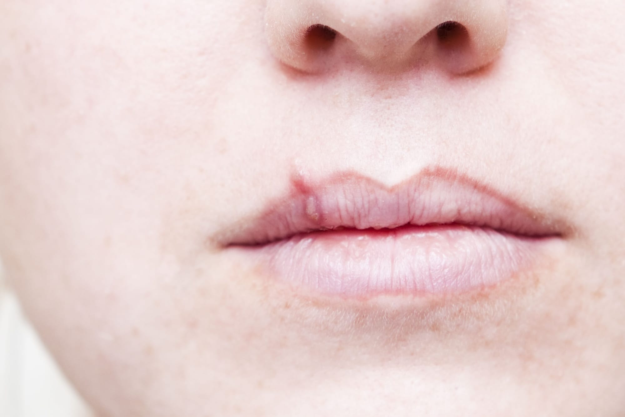 Cara Mengatasi Herpes dengan Obat Herpes