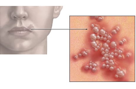 herpes-11