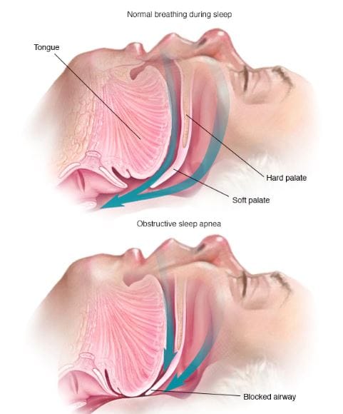 sleep apnea