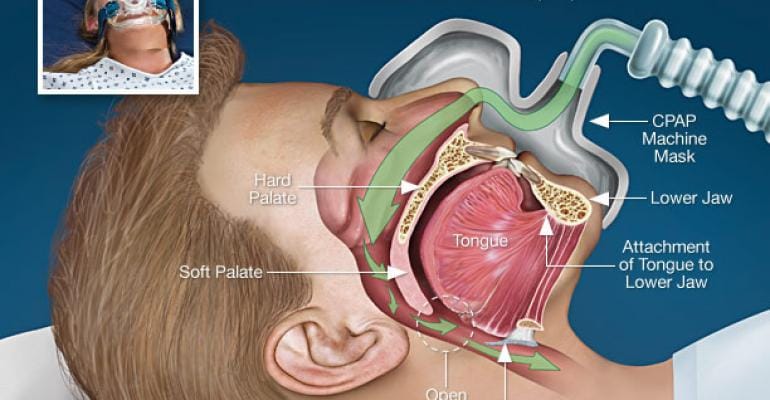 Fungsi Alat CPAP dan BPAP untuk Sleep Apnea Gangguan Tidur