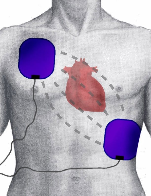 AED Defibrillator