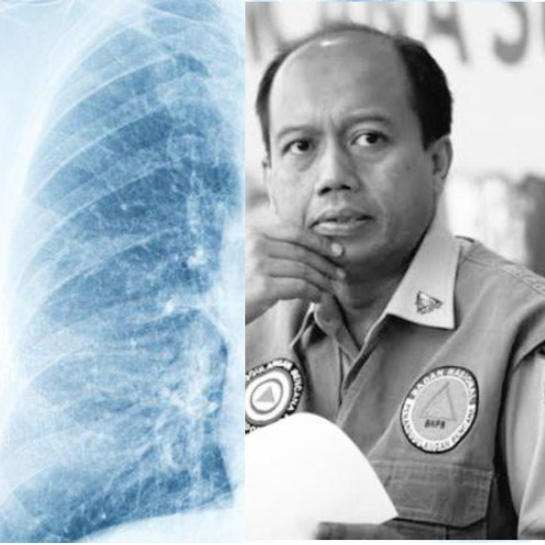 Ini dia 5 Gejala dan Pemicu Kanker Paru seperti yang Diderita Sutopo