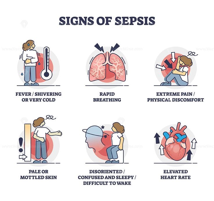 Signs of sepsis as infection blood poisoning symptoms outline collection