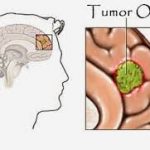 Ketahui Penyebab, Gejala dan Jenis Tumor Otak
